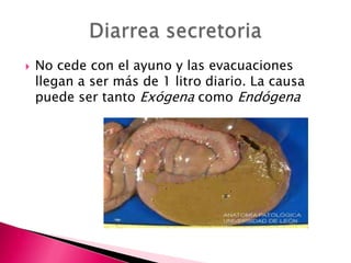   No cede con el ayuno y las evacuaciones
    llegan a ser más de 1 litro diario. La causa
    puede ser tanto Exógena como Endógena
 