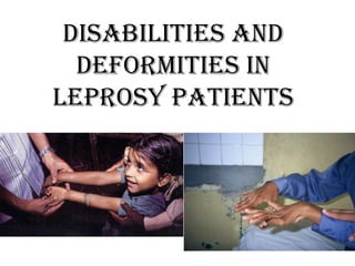 DISABILITIES AND
  DEFORMITIES IN
LEPROSY PATIENTS
 