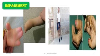 impairment
4/13/2022 7
Dr. C. BEULAH JAYARANIi
 