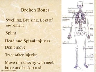 © Donald William Reid 2007
Broken Bones
Swelling, Bruising, Loss of
movement
Splint
Head and Spinal injuries
Don’t move
Treat other injuries
Move if necessary with neck
brace and back board
 
