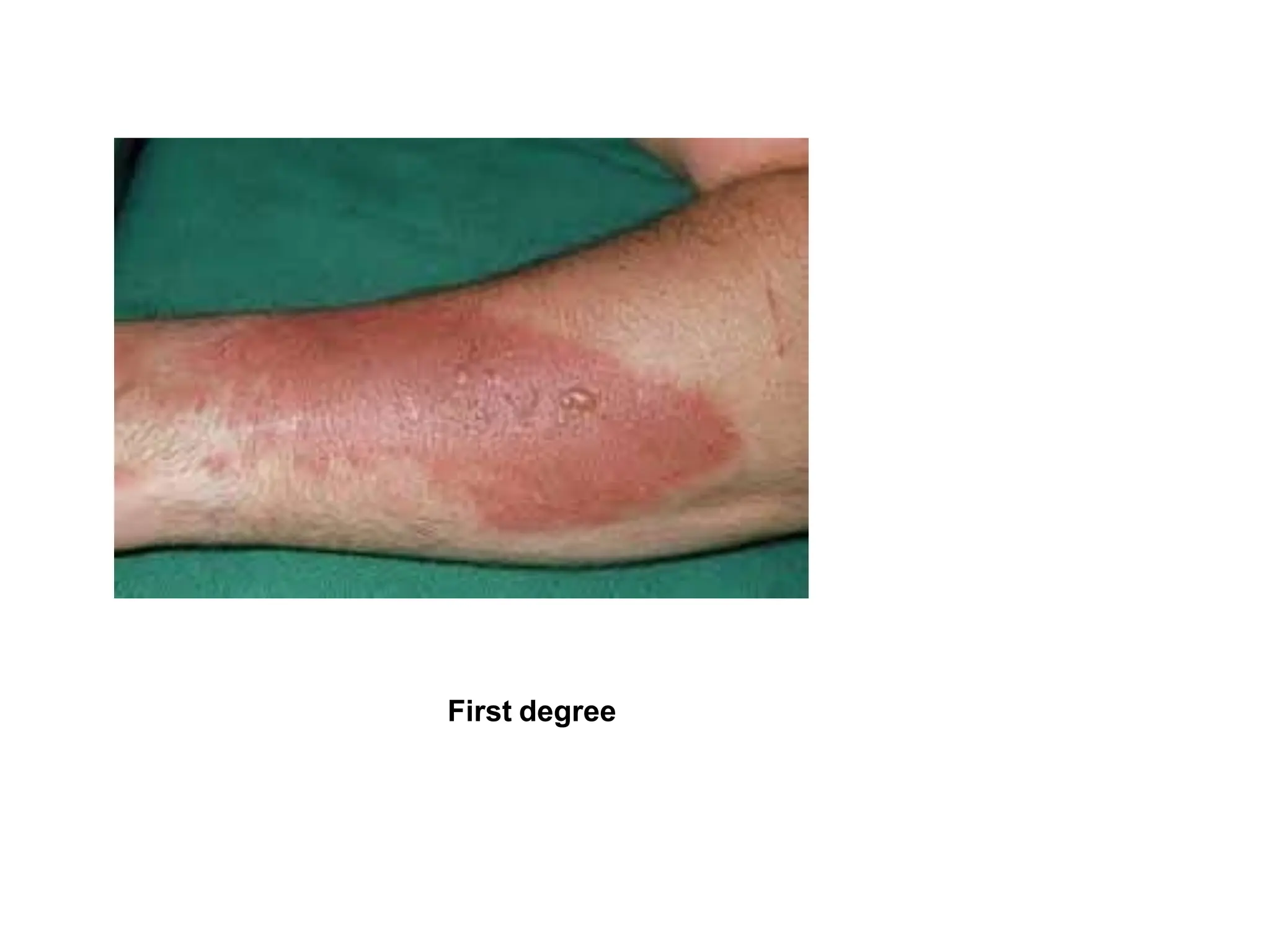 Diaster Injuries Disaster Triage Thermal Injuries Management.ppt