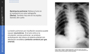 Barotrauma pulmonar. Nótese el aire en
el mediastino en esta radiografía
(flecha). También hay aire en los tejidos
blandos del cuello
11
La lesión pulmonar por insuflación excesiva puede
causar neumotórax. Si el aire entra a la
circulación venosa pulmonar, se produce
embolización del mismo al sistema arterial con
afectación encefálica (embolia cerebral por gas
arterial)
Snyder
B,
&
Neuman
T
(2013).
Disbarismo
y
complicaciones
del
buceo.
Tintinalli
J.E.,
&
Stapczynski
J,
&
Ma
O,
&
Cline
D.M.,
&
Meckler
G.D.,
&
Cydulka
R.K.(Eds.),
Tintinalli.
Medicina
de
urgencias,
7e.
McGraw
Hill.
 