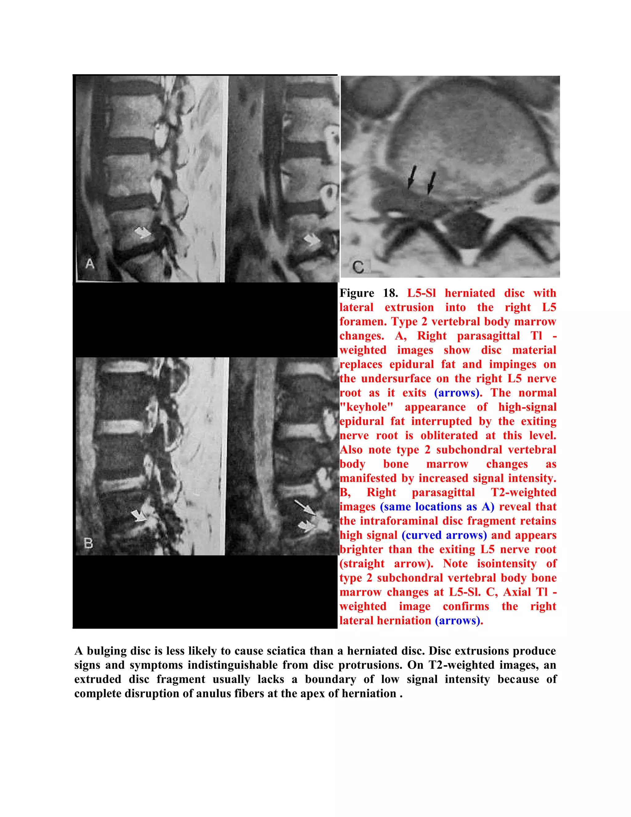 Radiological pathology of Disc degeneration | PDF | Bone and Joint ...