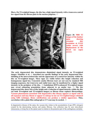 Radiological pathology of Disc degeneration | PDF