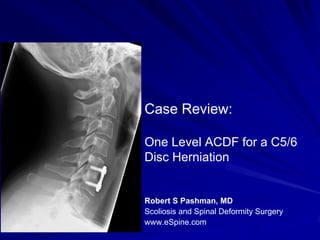Case Review:

One Level ACDF for a C5/6
Disc Herniation


Robert S Pashman, MD
Scoliosis and Spinal Deformity Surgery
www.eSpine.com
 