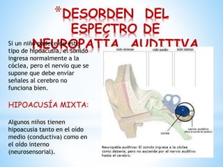 *DESORDEN DEL
ESPECTRO DE
NEUROPATÍA AUDITIVASi un niño padece de este
tipo de hipoacusia, el sonido
ingresa normalmente a la
cóclea, pero el nervio que se
supone que debe enviar
señales al cerebro no
funciona bien.
HIPOACUSÍA MIXTA:
Algunos niños tienen
hipoacusia tanto en el oído
medio (conductiva) como en
el oído interno
(neurosensorial).
 