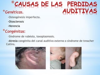 *CAUSAS DE LAS PERDIDAS
AUDITIVAS*Genéticas.
-Osteogénesis imperfecta.
-Otosclerosis
-Herencia
*Congénitas:
-Síndrome de rubéola, toxoplasmosis.
-Atresia congénita del canal auditivo externo o síndrome de treacher
Collins.
 