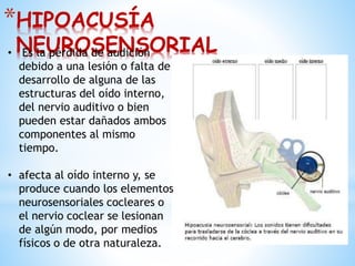 *HIPOACUSÍA
NEUROSENSORIAL• Es la pérdida de audición
debido a una lesión o falta de
desarrollo de alguna de las
estructuras del oído interno,
del nervio auditivo o bien
pueden estar dañados ambos
componentes al mismo
tiempo.
• afecta al oído interno y, se
produce cuando los elementos
neurosensoriales cocleares o
el nervio coclear se lesionan
de algún modo, por medios
físicos o de otra naturaleza.
 