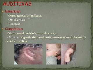  Genéticas.
   -Osteogénesis imperfecta.
   -Otosclerosis
   -Herencia
 Congénitas:
   -Síndrome de rubéola, toxoplasmosis.
   -Atresia congénita del canal auditivo externo o síndrome de
  treacher Collins.
 