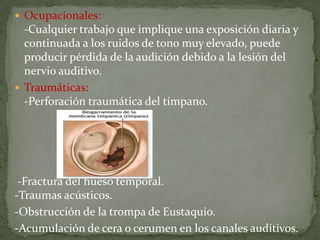  Ocupacionales:
  -Cualquier trabajo que implique una exposición diaria y
  continuada a los ruidos de tono muy elevado, puede
  producir pérdida de la audición debido a la lesión del
  nervio auditivo.
 Traumáticas:
  -Perforación traumática del tímpano.




 -Fractura del hueso temporal.
-Traumas acústicos.
-Obstrucción de la trompa de Eustaquio.
-Acumulación de cera o cerumen en los canales auditivos.
 