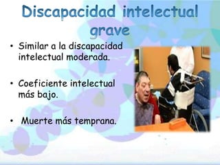 • Similar a la discapacidad
intelectual moderada.
• Coeficiente intelectual
más bajo.
• Muerte más temprana.
 