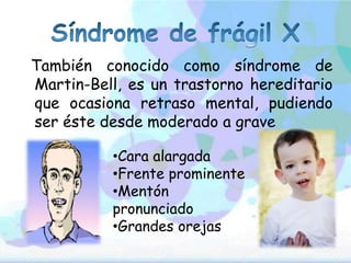 También conocido como síndrome de
Martin-Bell, es un trastorno hereditario
que ocasiona retraso mental, pudiendo
ser éste desde moderado a grave
•Cara alargada
•Frente prominente
•Mentón
pronunciado
•Grandes orejas
 