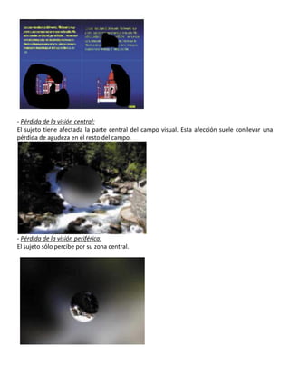 - Pérdida de la visión central:
El sujeto tiene afectada la parte central del campo visual. Esta afección suele conllevar una
pérdida de agudeza en el resto del campo.
- Pérdida de la visión periférica:
El sujeto sólo percibe por su zona central.
 