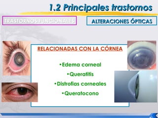 1.2 Principales trastornos
TRASTORNOS FUNCIONALES        ALTERACIONES ÓPTICAS




          RELACIONADAS CON LA CÓRNEA


                 •Edema corneal
                    •Queratitis
               •Distrofias corneales
                 •Queratocono
 