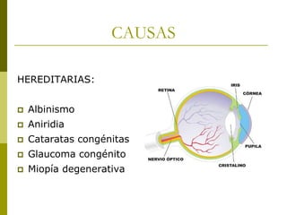 CAUSAS
HEREDITARIAS:


Albinismo



Aniridia



Cataratas congénitas



Glaucoma congénito



Miopía degenerativa

 