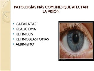 PATOLOGÍAS MÁS COMUNES QUE AFECTAN LA VISIÓN CATARATAS GLAUCOMA RETINOSIS RETINOBLASTOMAS ALBINISMO 