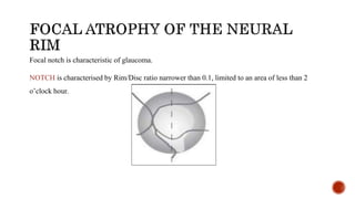 Focal notch is characteristic of glaucoma.
NOTCH is characterised by Rim/Disc ratio narrower than 0.1, limited to an area of less than 2
o’clock hour.
 