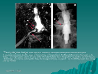 Nerogram Injection Disc Herniation | PPT