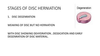 STAGES OF DISC HERNIATION
1. DISC DEGENRATION
WEAKING OF DISC BUT NO HERNIATION
WITH DISC SHOWING DEHYDRATION , DESSICATION AND EARLY
DEGENRATION OF DISC MATERIAL.
 