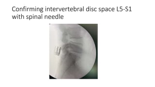 Confirming intervertebral disc space L5-S1
with spinal needle
 