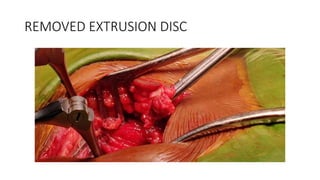 REMOVED EXTRUSION DISC
 