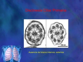 Discinesia Ciliar Primaria
Ausencia de brazos internos, externos
 