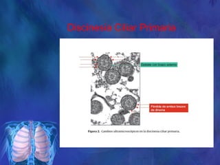 Discinesia Ciliar Primaria
 