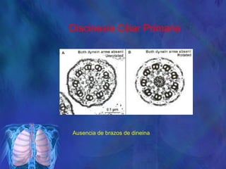 Discinesia Ciliar Primaria
Ausencia de brazos de dineina
 