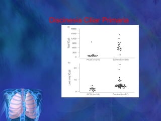 Discinesia Ciliar Primaria
 
