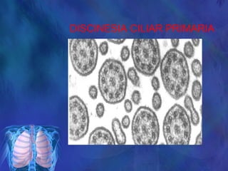 DISCINESIA CILIAR PRIMARIA
 