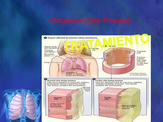 Discinesia Ciliar Primaria
 