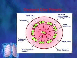 Discinesia Ciliar Primaria
 