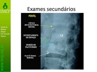 Exames secundários
• Radiografia
– Alterações surgem entre 2 semanas e 3 meses
– Irregularidade da placa terminal
• erosões nas placas vertebrais são os primeiros achados
radiográficos
– Estreitamento do espaço discal
– Formação de osso hipertrófico (esclerótico)
– Achados tardios
• Colapso vertebral, cifose regional e anquilose óssea
– Tuberculose
• fina calcificação do tecido mole paravertebral
 