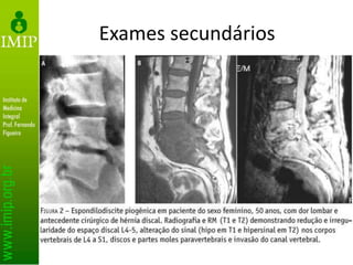 Exames secundários
• RNM
– Determina extensão da infecção
– Identifica tecidos acometidos
– Não identifica etiologia
• Não exclui biópsia
 