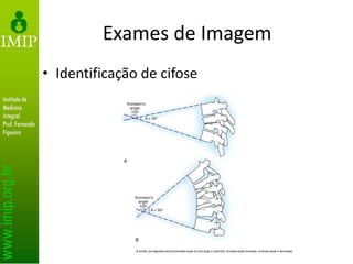 Exames de Imagem
• Identificação de cifose
 