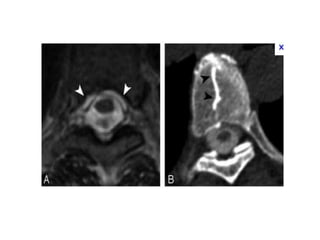 Discitis | PPTX