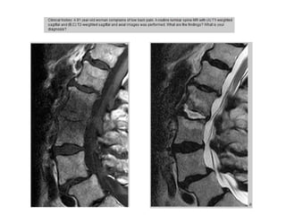 Discitis | PPTX