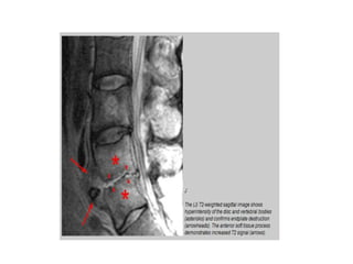 Discitis | PPTX