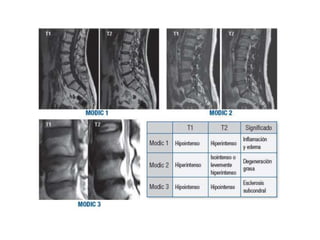 Discitis | PPTX