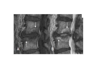 Discitis | PPTX