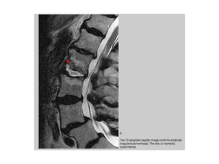 Discitis | PPTX