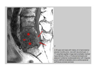Discitis | PPTX