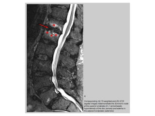 Discitis | PPTX