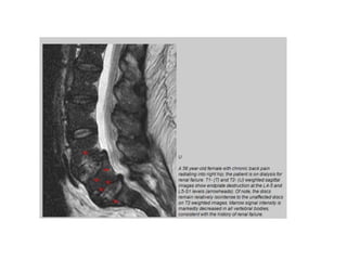 Discitis | PPTX