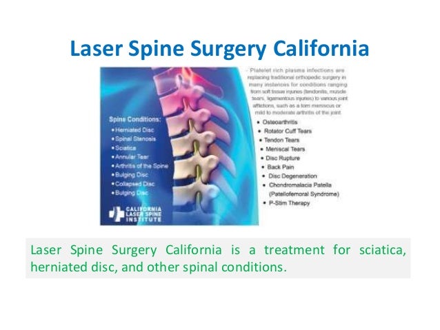 Laser Spine Surgery California