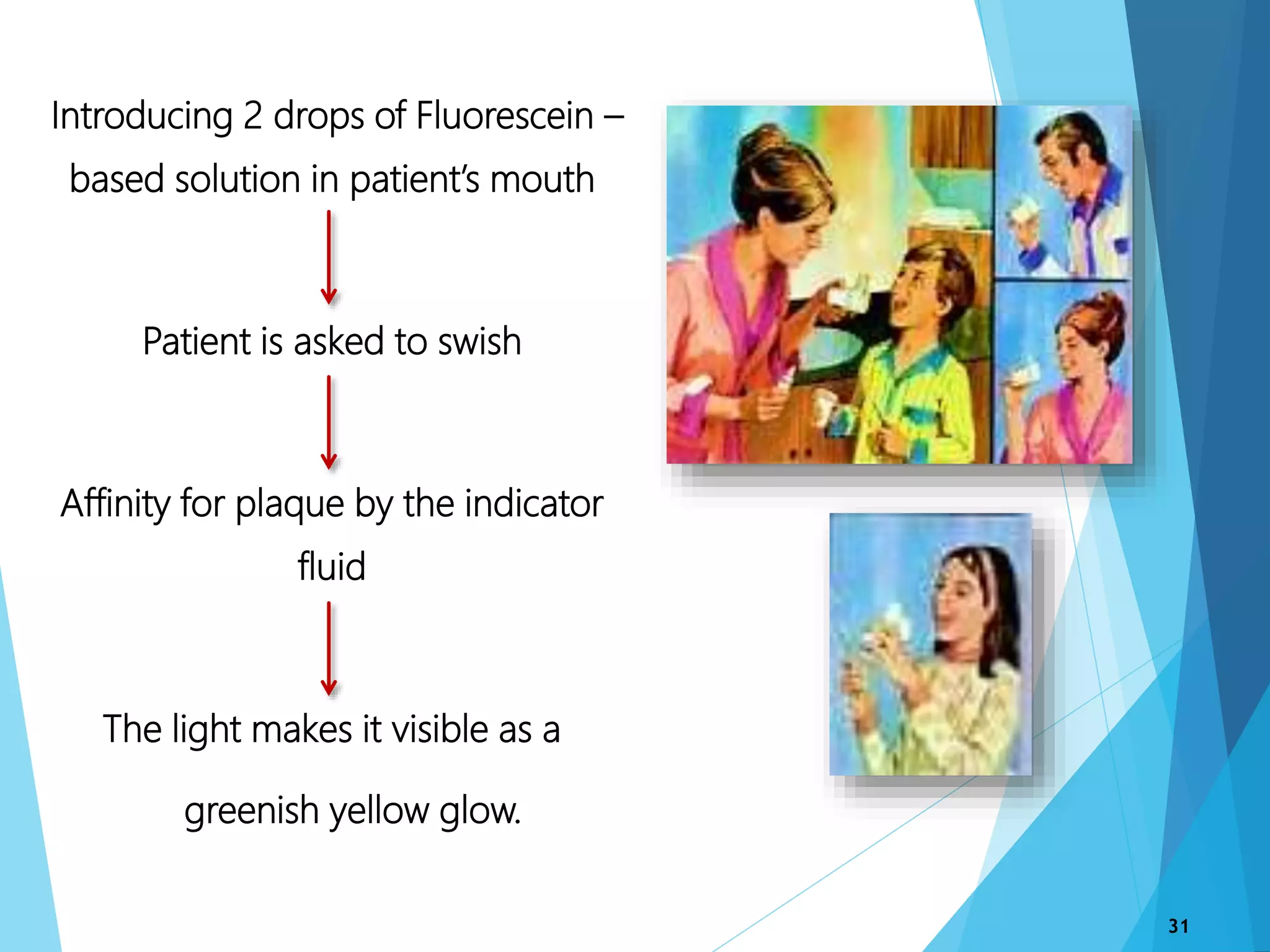 Introducing 2 drops of Fluorescein –
based solution in patient’s mouth
Patient is asked to swish
Affinity for plaque by the indicator
fluid
The light makes it visible as a
greenish yellow glow.
31
 