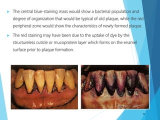  The central blue-staining mass would show a bacterial population and
degree of organization that would be typical of old plaque, while the red
peripheral zone would show the characteristics of newly formed plaque.
 The red staining may have been due to the uptake of dye by the
structureless cuticle or mucoprotein layer which forms on the enamel
surface prior to plaque formation.
34
 