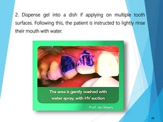 2. Dispense gel into a dish if applying on multiple tooth
surfaces. Following this, the patient is instructed to lightly rinse
their mouth with water.
45
 