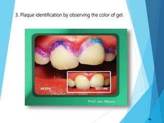 3. Plaque identification by observing the color of gel.
46
 