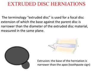 Discogenic lower backache by DR.NAVEEN RATHOR | PPTX